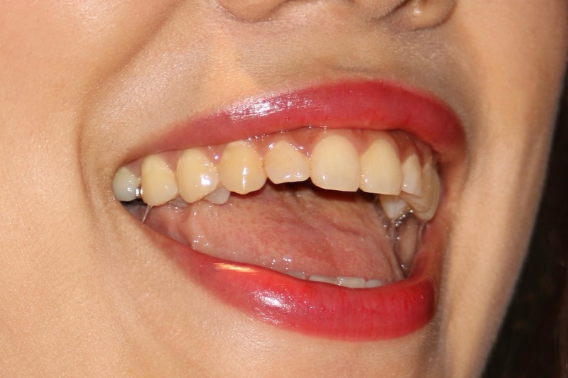 コンパニオンの口①